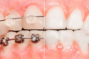 矯正歯科と審美歯科